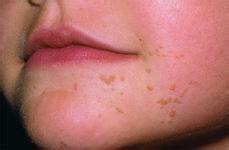 ƽ༤ǲܹ׵hpv?