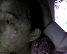 扁平疣中医治疗有什么好的药物彻底根治呢?