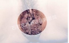 尖锐湿疣哪种方法医治能去除症状和损害?