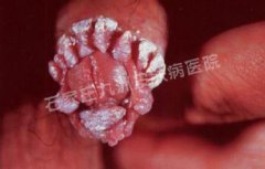 尖锐湿疣中医治疗都有哪些外用药物呢?