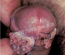 尖锐湿疣治疗反复复发都是哪些原因?