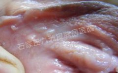 生活当中如何预防感染宫颈尖锐湿疣?
