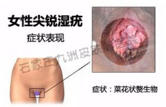 尖锐湿疣光动力治疗后如何预防复发呢?