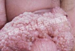 阴茎感染性病湿疣有什么药物方法治愈呢?