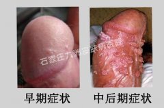 包皮尖锐湿疣用什么物理方法治疗好呢?