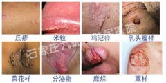尖锐湿疣除了症状损害还有哪些影响伤害?