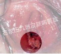 阴道尖锐湿疣治疗采用什么方法好呢?