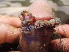 尖锐湿疣怎样安全有效的治愈清除呢?