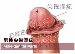  尖锐湿疣如何对症选择治疗药物和方法呢?