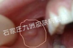 感染尖锐湿疣应当如何治疗和护理呢?
