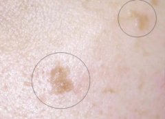 扁平疣应当如何使用艾灸方法治愈去除症状呢?