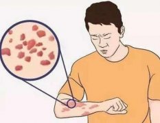 荨麻疹症状损害能不能使用激素药物治疗去除呢?