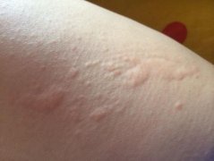 荨麻疹患者如何使用拔罐的方法治疗去除症状?