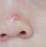 青春痘患者应当如何选择药物方法去除顽固的症状呢?