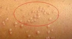 扁平疣发病的时候有没有自觉症状以及如何护理好呢?